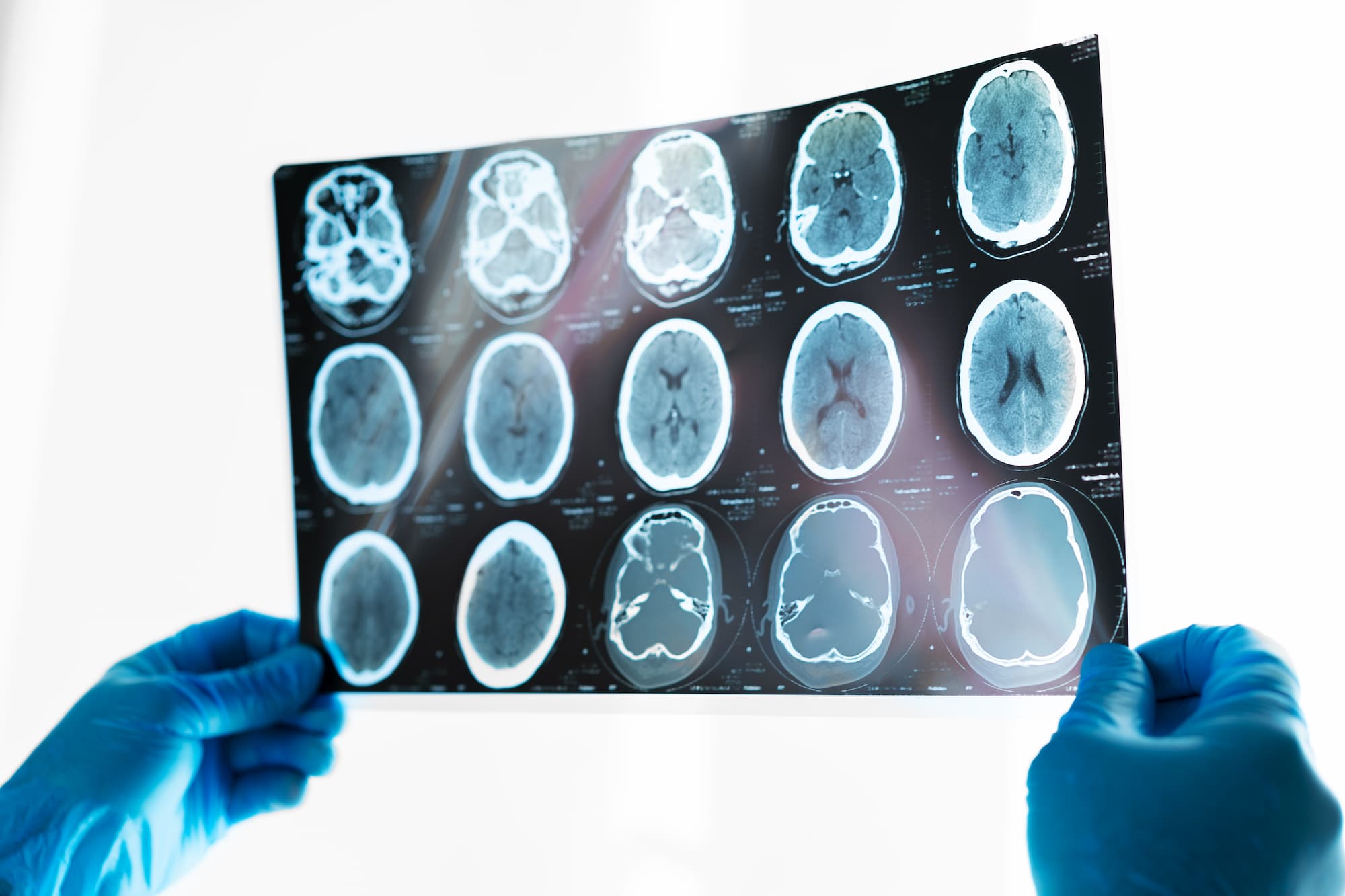 Legal options for brain injury victims
