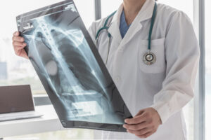 Symptoms of a Broken Tailbone