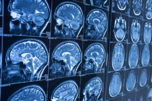 Why Hire AJ Law, PLC if You’ve Suffered a Traumatic Brain Injury in Tucson?